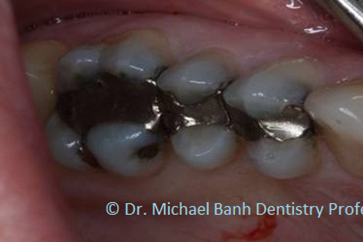 Clinical-Case-Case--Why-crowns-are-recommended-for-teeth-with-large-fillings