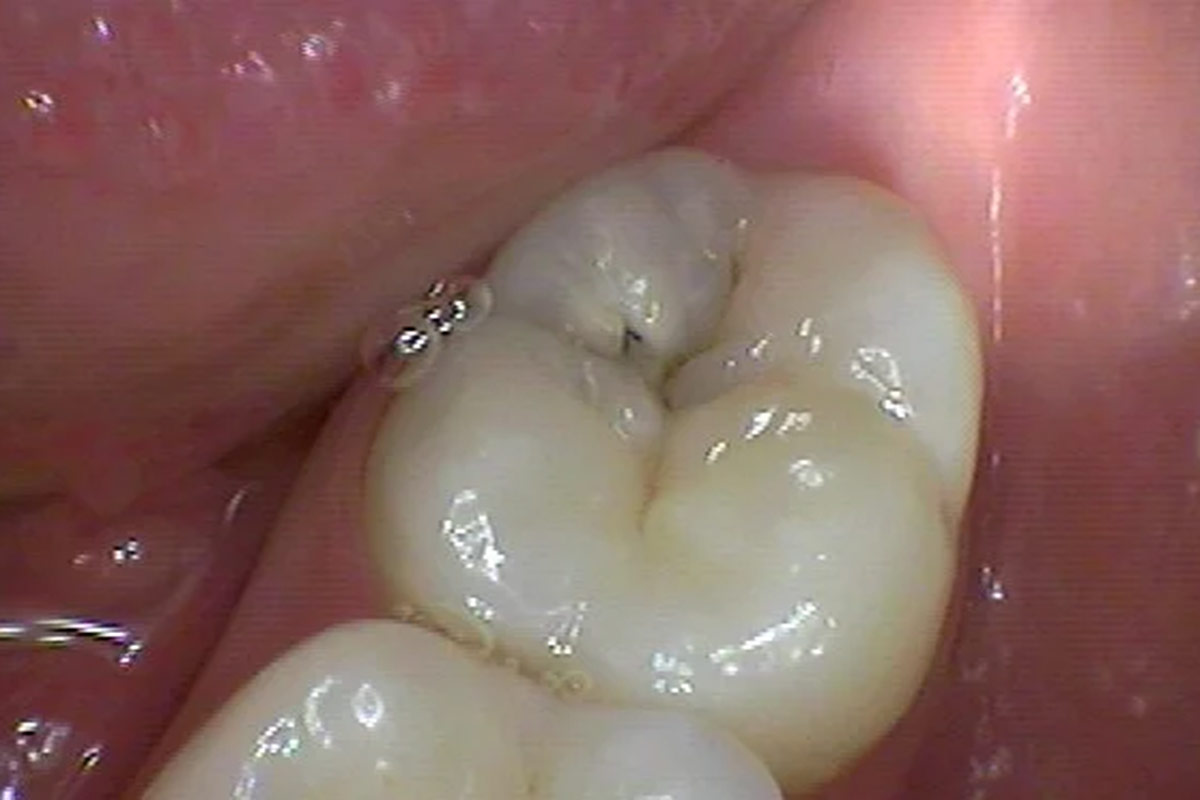 Tooth-Decay-what-does-a-cavity-actually-look-like