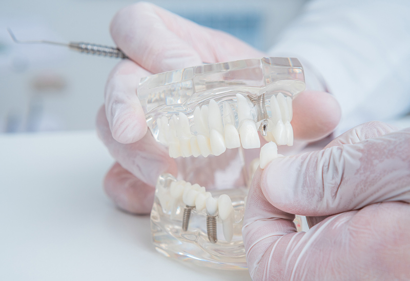 dental-implants-uxbridge-family-dentistry
